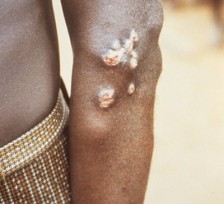 Jaas (framboesia), afbeelding Wikipedia/United States Department of Health and Human Services.